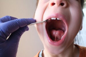 Kid with open mouth showing tongue-tie.